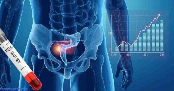 Medical illustration of PSA test results after prostate removal showing prostate gland, blood test tube, and rising PSA levels indicating recurrence risk.